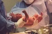 هشدار وزارت بهداشت درباره سزارین‌های ۱۴۰۲/۰۲/۰۲