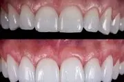 کامپوزیت ونیر و لمینت زیبایی دندان در دندانپزشکی هروی

