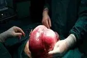 توده 5 کیلویی از شکم یک بیمار خارج شد