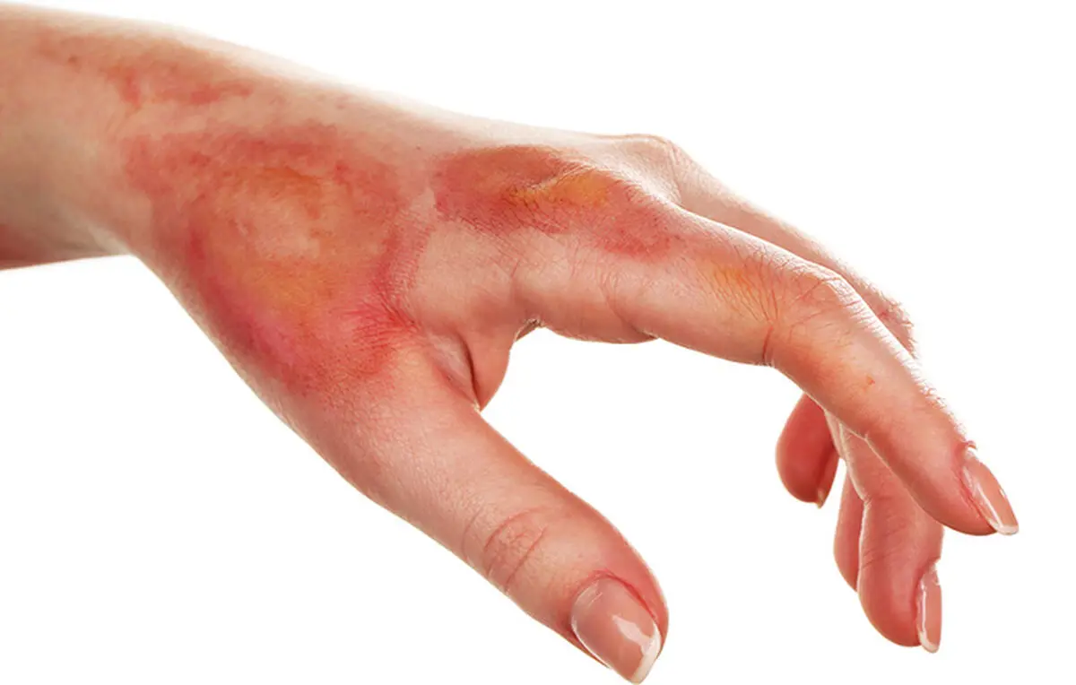 با آفتاب سوختگی چه کنیم؟