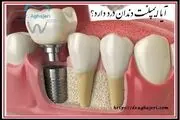 ایمپلنت دندان در 8 دقیقه