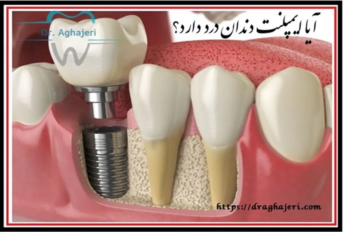 ایمپلنت دندان در 8 دقیقه