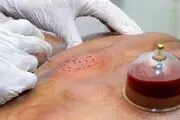 هشدار وزارت بهداشت درخصوص انجام فصد، حجامت و زالو درمانی
