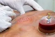 هشدار وزارت بهداشت درخصوص انجام فصد، حجامت و زالو درمانی
