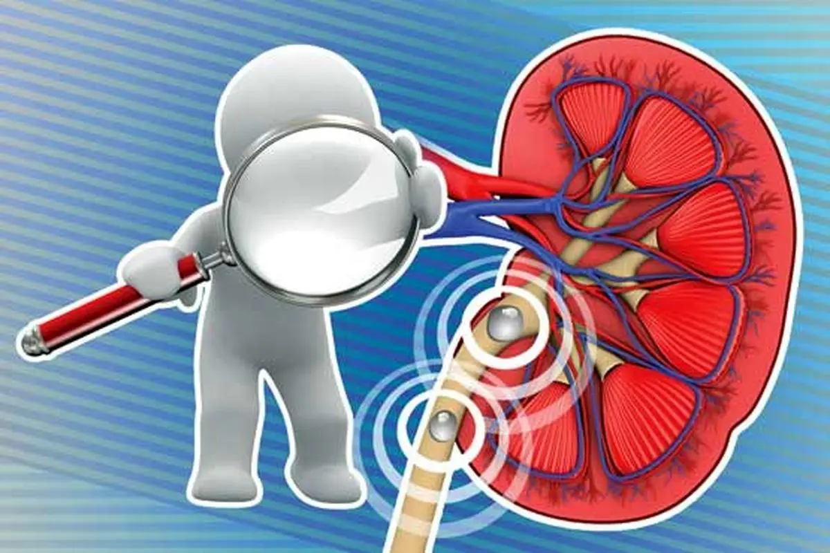 چه کار کنیم تا سنگ کلیه نگیریم؟