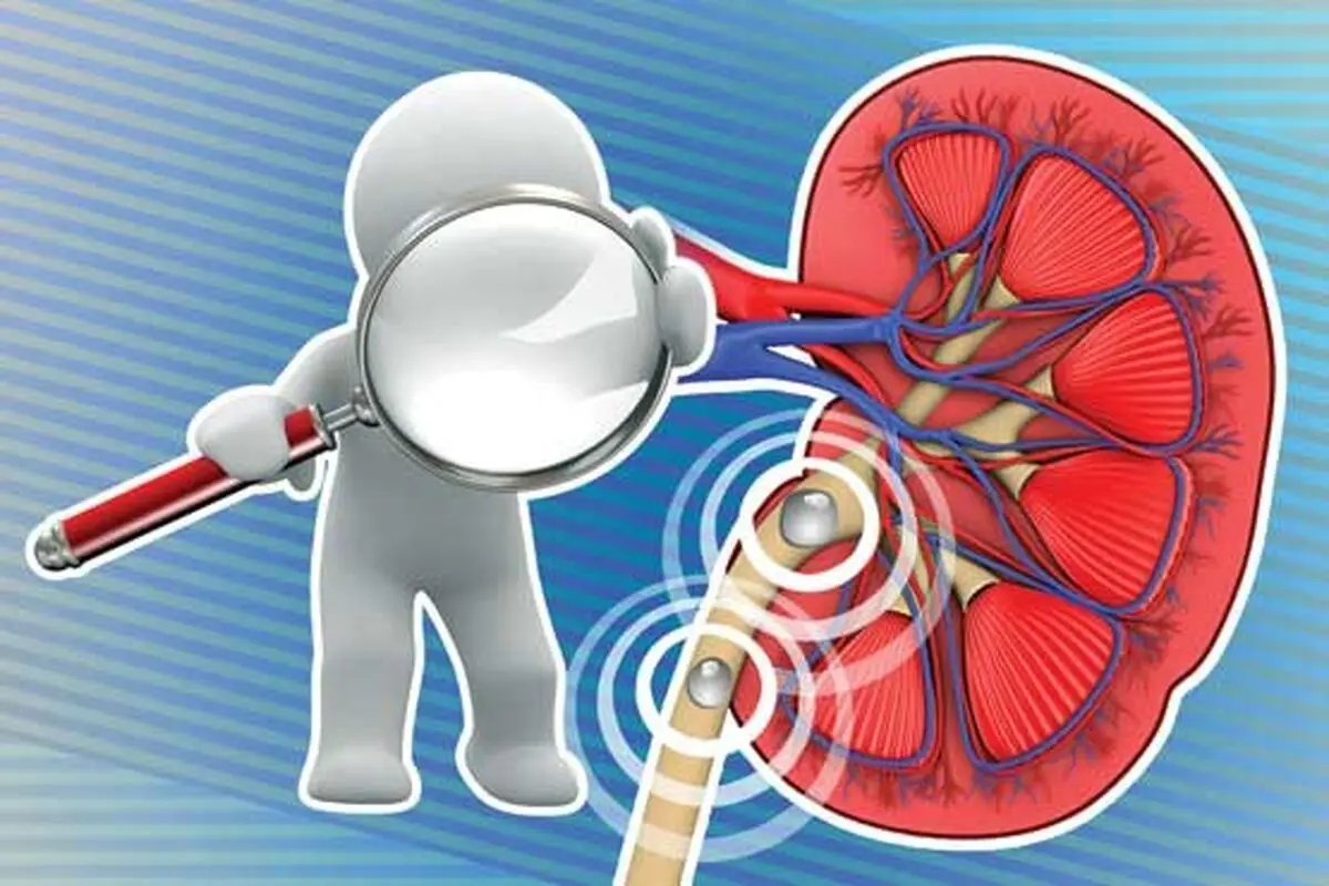 گوشت قرمز تاثیری در تشکیل سنگ کلیه دارد؟