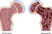 
اشتباهاتی که استخوان‌ها را پوک می‌کنند

