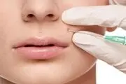 عوارض احتمالی تزریق ژل و فیلر در صورت 