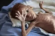 هشدار سازمان ملل در مورد گرسنگی در یمن