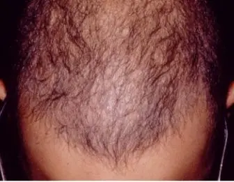 ۷ عامل اصلی در ریزش مو