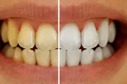 راهی معجزه آسا برای سفید کردن دندان