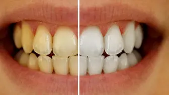 راهی معجزه آسا برای سفید کردن دندان