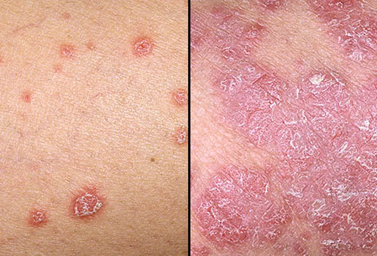 چگونه از خشک شدن «پوست» جلوگیری کنیم؟