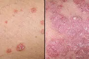 چگونه از خشک شدن «پوست» جلوگیری کنیم؟
