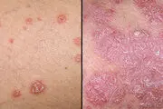 چگونه از خشک شدن «پوست» جلوگیری کنیم؟
