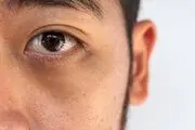 عواملی که باعث تیرگی دور چشم می‌شوند
