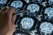 کدام عوامل می‌تواند بروز سکته مغزی را در افراد کاهش دهد؟
