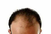 کشک عامل اصلی ریزش مو