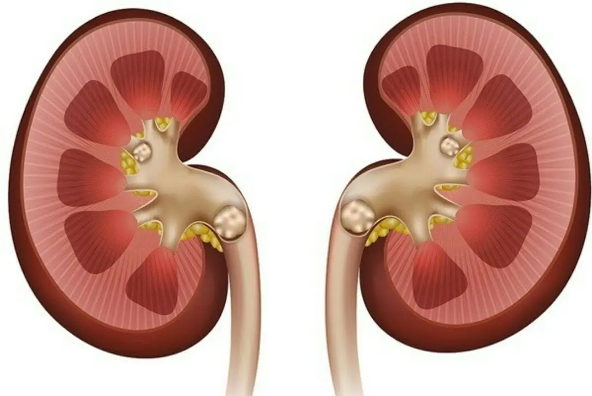 
برای جلوگیری از سنگ کلیه چقدر آب بخوریم؟
