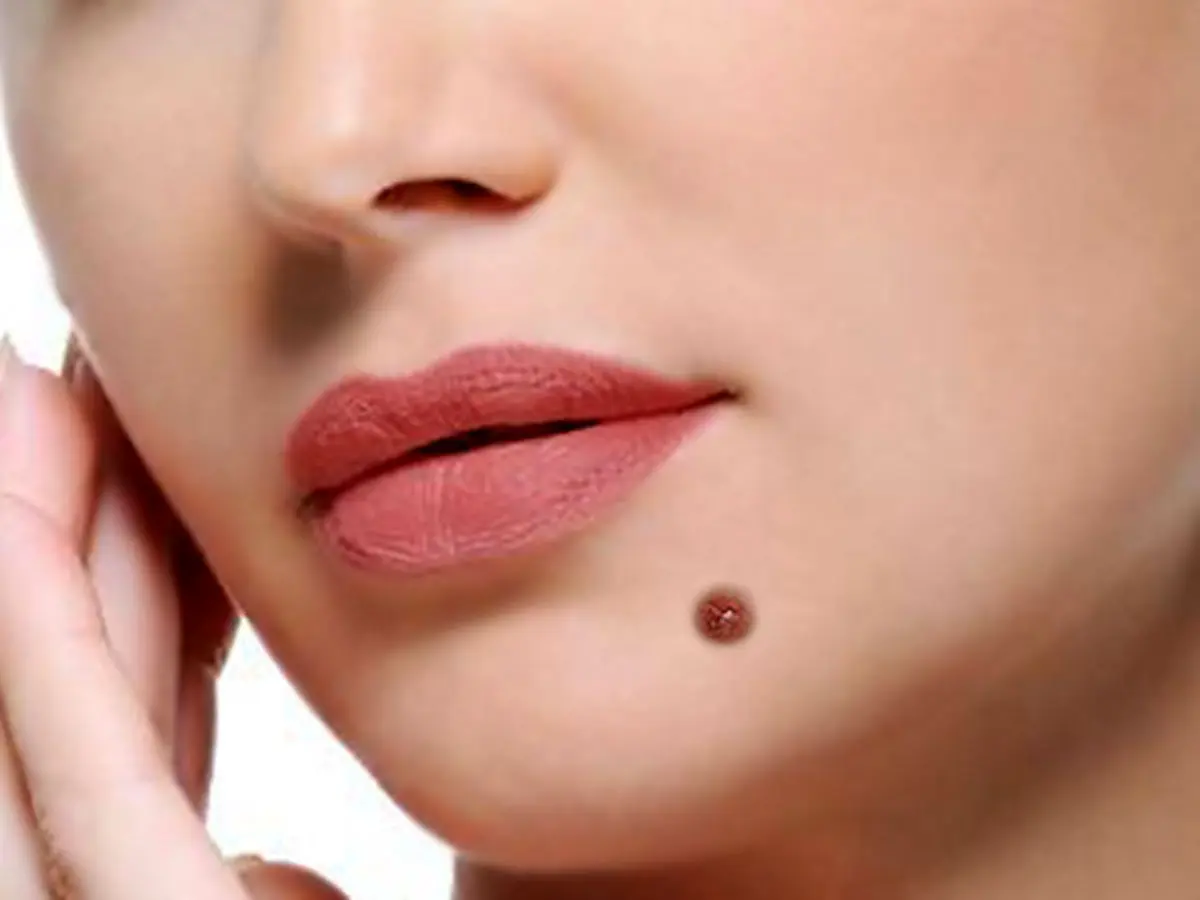 آیا خال ها نیاز به جراحی دارند؟