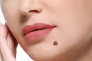 آیا همه خال ها خطرناک هستند؟