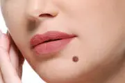 خال کوچکی که تبدیل به یک تومور وحشتناک شد +عکس