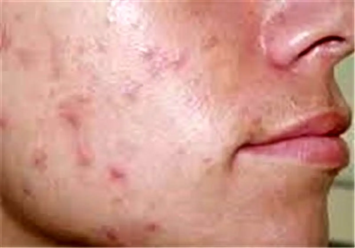 حجامت برای افراد لاغر و کمخون مضر است