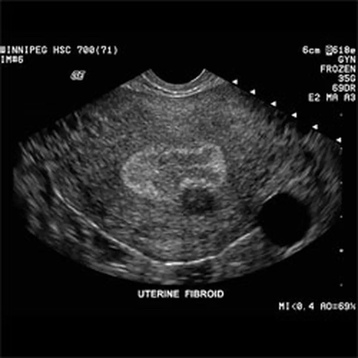 فیبرم‌ رحمی چیست؟