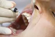 علل و راه‌های درمان عقب نشینی لثه
