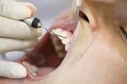 علل و راه‌های درمان عقب نشینی لثه
