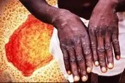 مورد مشکوکی از ابتلا به آبله میمونی در کشور مشاهده نشده است
