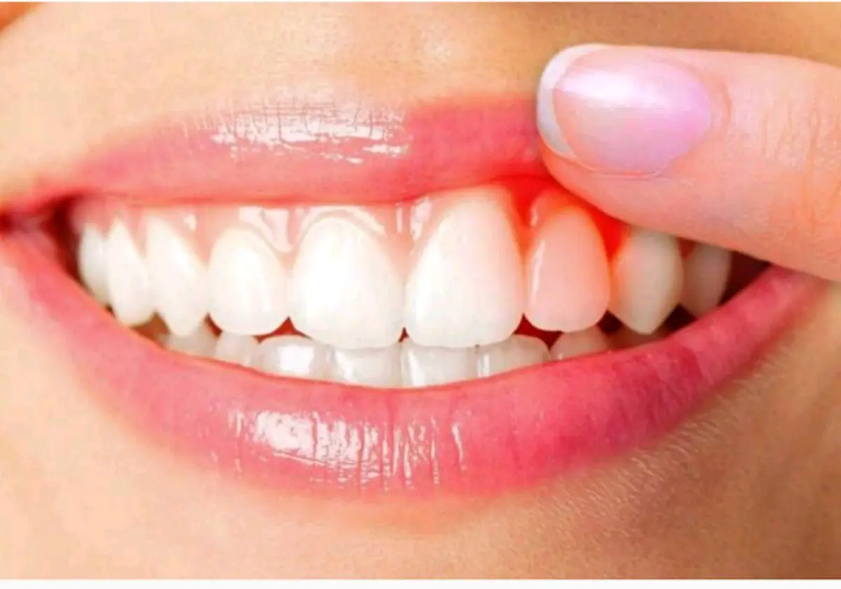 دیابتی‌ها و مشکلات لثه