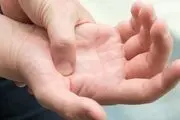 دلیل ابتلا به سندرم کارپال و روش درمان