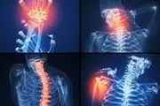 این غذاها سبب تشدید آرتروز می شوند