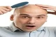 علل ریزش موی سکه‌ای