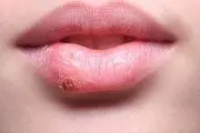 با این روش به سرعت تبخال را از بین ببرید