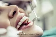لمینت سرامیکی بهتر است یا کامپوزیت؟

