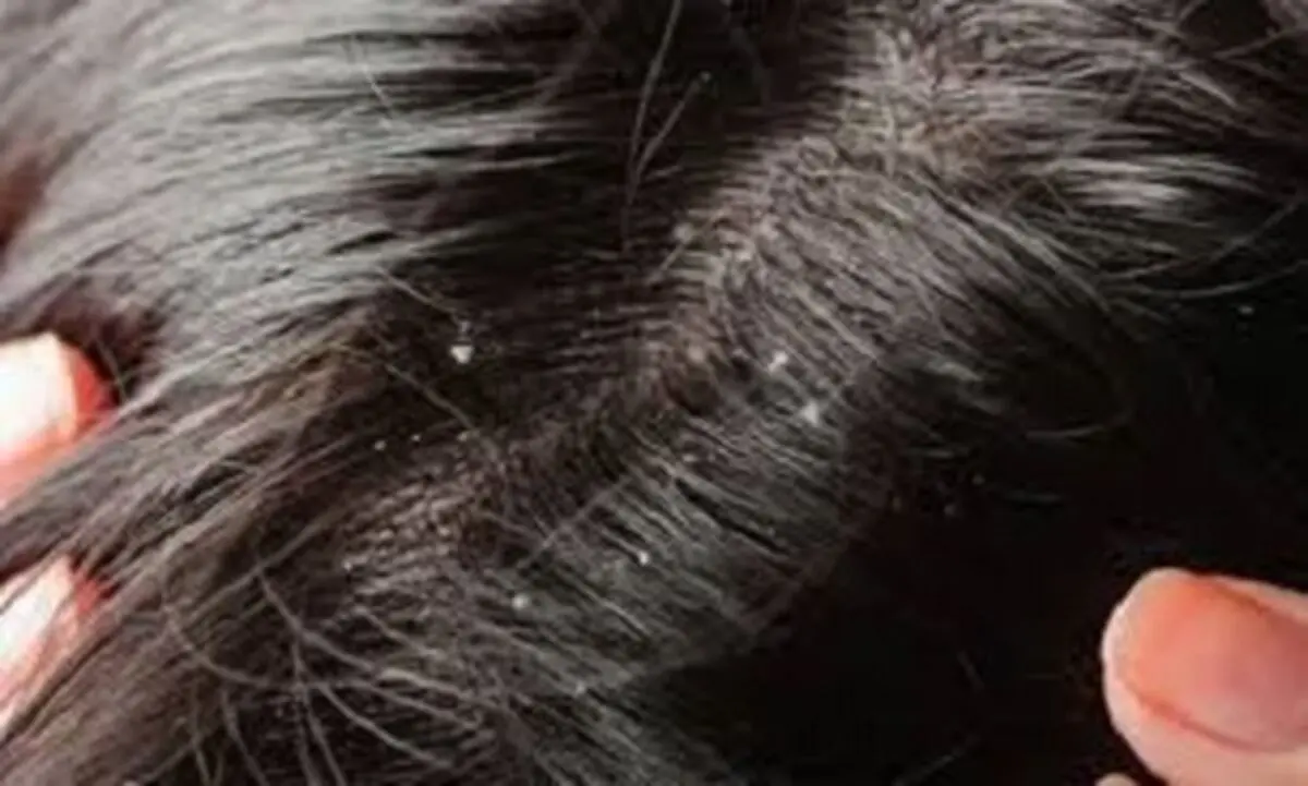 چرا سرمان شوره می زند؟