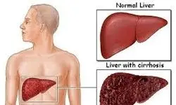 درمان سنتی کبدچرب