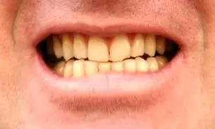چرا دندان ها زرد می شوند؟