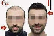 مراحل کاشت مو و ابرو چیست؟