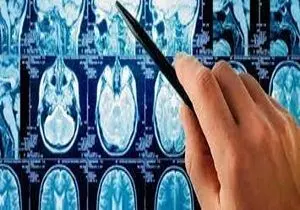 روش جدید درمان تومور‌های مغزی
