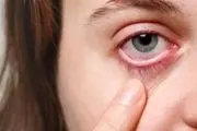 علل بروز عارضه چشم صورتی و راه‌های درمان آن