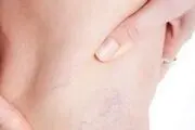 درمان واریس به روش خانگی + آموزش