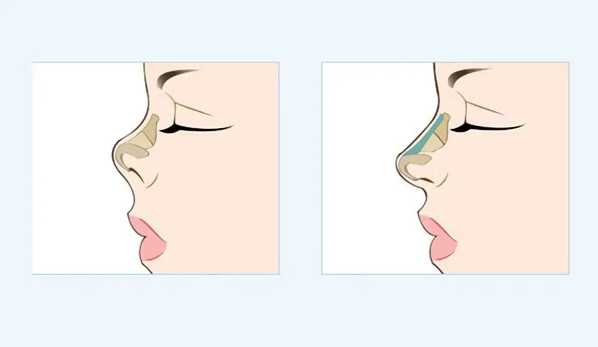 آشنایی با عمل زیبایی بینی و مزایا و عوارض آن