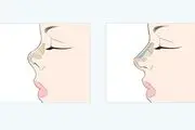  آشنایی با عمل زیبایی بینی و مزایا و عوارض آن