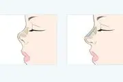  آشنایی با عمل زیبایی بینی و مزایا و عوارض آن