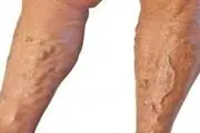 اگر واریس دارید بخوانید!