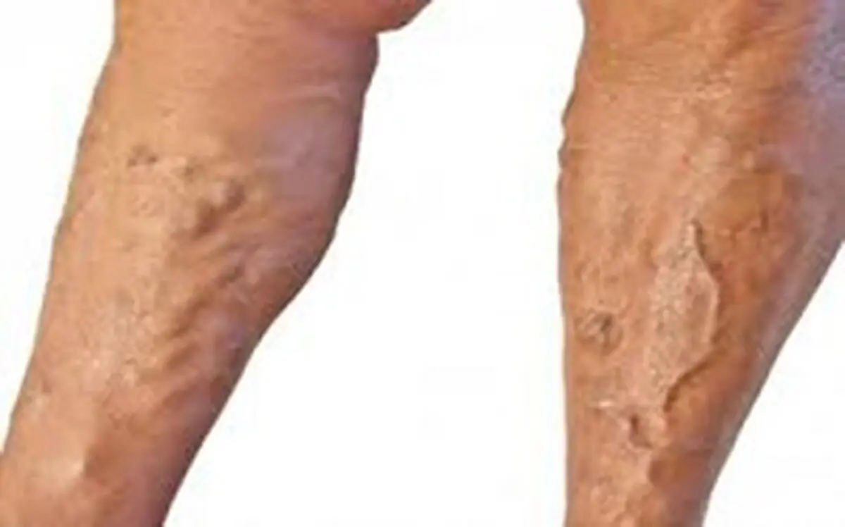 اگر واریس دارید بخوانید!