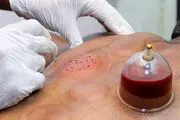 حجامت بر سلامت انسان چه تاثیراتی دارد؟